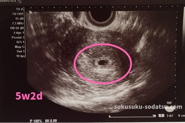 心拍確認はいつ 妊娠初期の赤ちゃんエコー写真と経過 体験談 ままやすみ