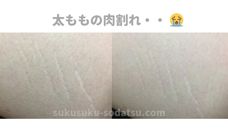 ノコアで肉割れは消える?